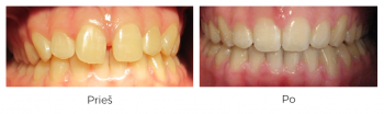 Gydymas breketais. Diastema