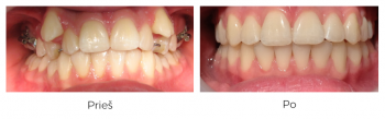 Gydymas breketais. Gydymas - vietos sukūrimas Distal Jet aparatu