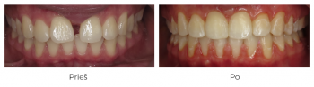 Gydymas breketais. Diastema - tarpas tarp priekinių dantų