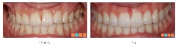 Kreivi dantys, gydymas Invisalign, trukmė 12 mėnesių