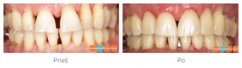 Lėtinis periodontitas, dantų atsikišimas, gydymas Invisalign, trukmė 12 mėnesių